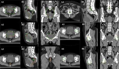 The clinical evaluation of atlas-based auto-segmentation for automatic contouring during cervical cancer radiotherapy